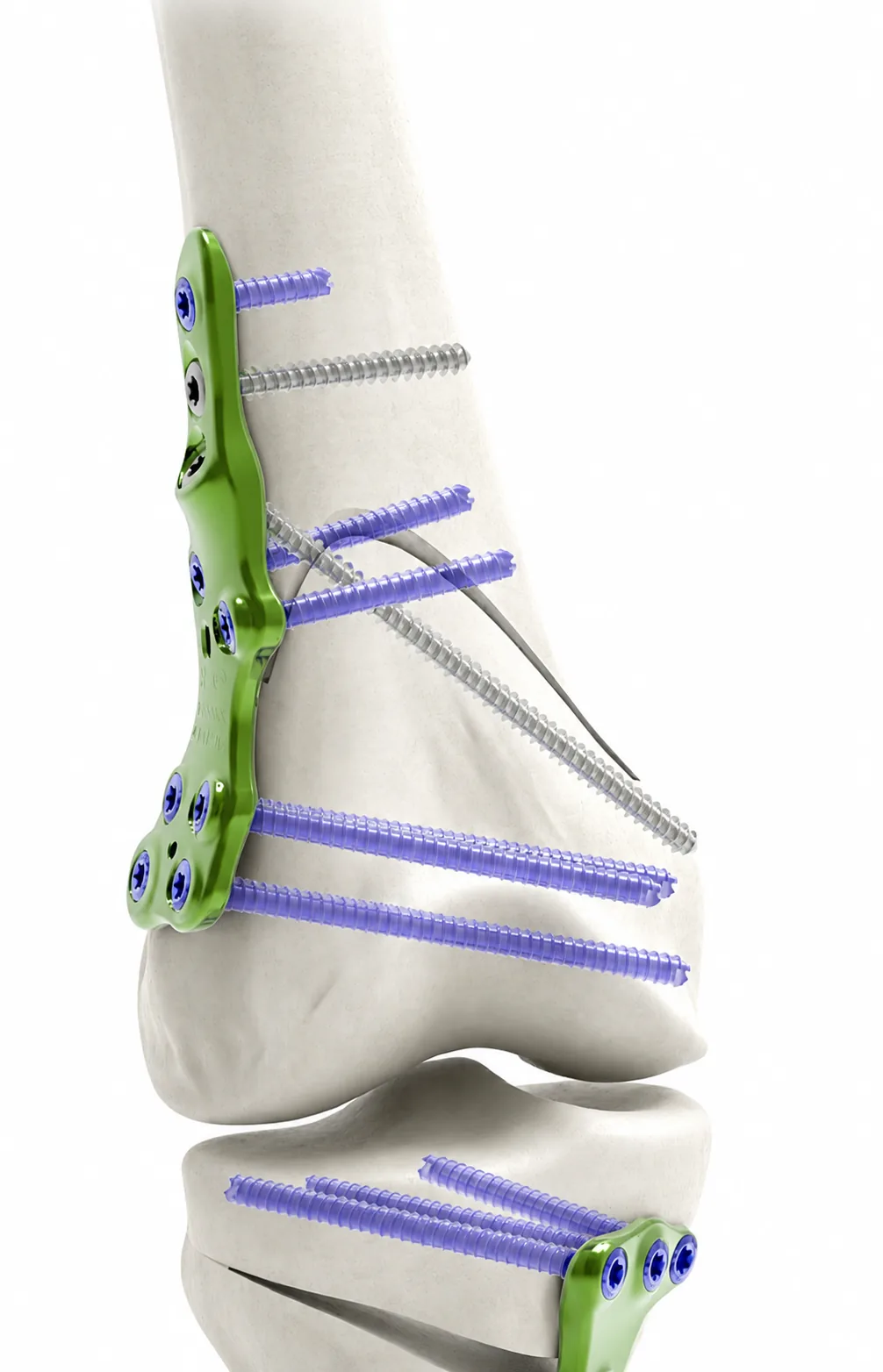 Lateral Closing Distal Femoral Osteotomy (DFO) Plate